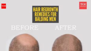 Reverse male pattern baldness: Home remedies for hair regrowth in balding men