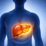 Can fatty liver be undone? This case suggests it can
