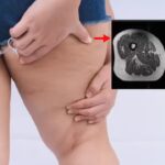 Ultra-Processed Foods: Ultra-processed foods linked to thigh fat accumulation and osteoarthritis.