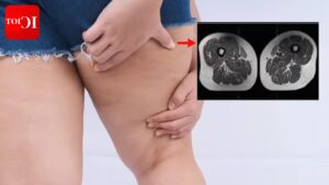 Ultra-Processed Foods: Ultra-processed foods linked to thigh fat accumulation and osteoarthritis.