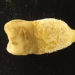 700-year-old Bolivian mummy tooth reveals scarlet fever bacterium before Europeans arrived |