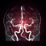 Cerebral Angiography: 7 silent warning signs that may mean you need a Cerebral Angiography