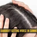 Dandruff Symptoms: Why your dandruff gets worse in summer: The heat and humidity connection explained