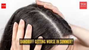 Dandruff Symptoms: Why your dandruff gets worse in summer: The heat and humidity connection explained